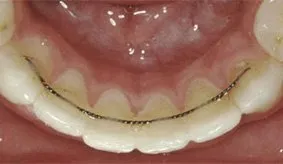 Gold Chain Lingual Retainer